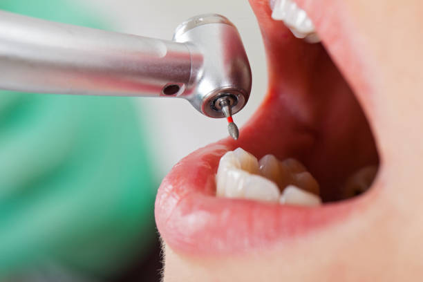 Best Emergency Dental Extractions in Exandria, AL